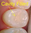 Cavities | Palm Beach County, Boynton Beach, West Palm Beach, Boca ...