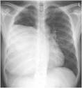 An Unusual Cause of Chest Pain