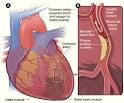 What Is a Heart Attack? - NHLBI, NIH