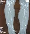 <b>Thromboangiitis obliterans</b>