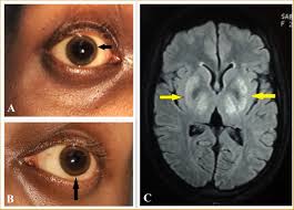 Kuvahaun tulos haulle Kayser-Fleischer