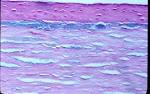 of the <b>Corneal Stroma</b>