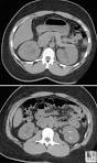 Cortical <b>nephrocalcinosis</b> is