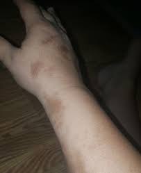 Attēlu rezultāti vaicājumam “Scleroderma”