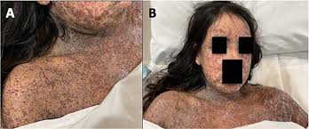 Attēlu rezultāti vaicājumam “Diderma simplex”