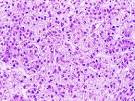 <b>hepatocellular carcinoma</b>