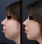 Chin Augmentation Manhattan | NYC | Manhattan