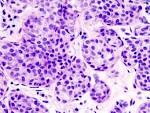 <b>lobular carcinoma</b> (2).jpg