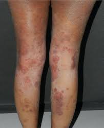 Image result for tinea corporis