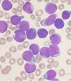 en una <b>Leucemia</b> linfoide