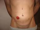 Photos 1: Colectomy « UC to J-Pouch Story