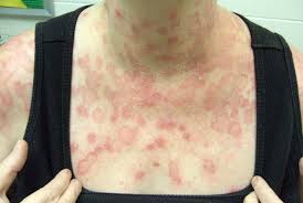 Image result for tinea corporis
