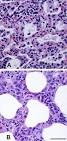 Severe <b>interstitial pneumonia</b>