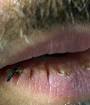 What Causes Dry Chapped Lips