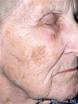 Hyperpigmentation