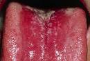 Dental Pictures: Gum Disease, Tongue Problems, Oral Cancer, Tooth ...