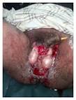 <b>Fournier's Gangrene</b>: Current Practices : Figure 1