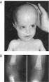 <b>Zellweger syndrome</b> showing