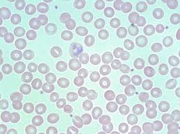 Attēlu rezultāti vaicājumam “undetermined plasmodium”