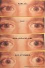 EyeRounds.org: Horner's Syndrome with Cluster Headache