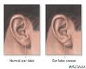 Heart Disease Risk Factors: Beware the Diagonal Earlobe Crease