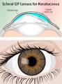 Large-diameter <b>scleral</b> and