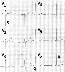 Image result for  v    q