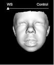 with williams syndrome