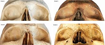 Attēlu rezultāti vaicājumam “Cribraria piriformis stalked”