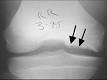 <b>Osteochondritis dissecans</b>