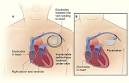 What Is an Implantable Cardioverter Defibrillator? - NHLBI, NIH
