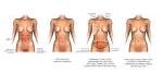 DIEP Flap Breast Reconstruction, The Woodlands, Katy, Conroe ...