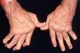 Severe <b>rheumatoid arthritis</b>