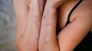 Image result for bed bug bites