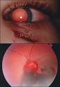 potential for <b>eye injury</b>,