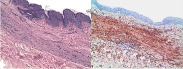 Attēlu rezultāti vaicājumam “Diderma chondrioderma sessile”