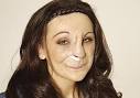 Rachel Rooney, 31, cruelly jeered “take your mask off” at 23-year-old ... - image-6-for-paper-pics-19-03-2011-gallery-878766950