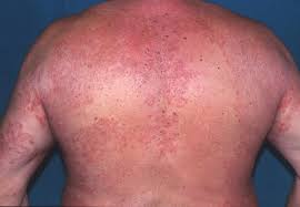 Image result for tinea corporis