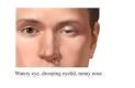 Cluster Headache — UVA Health