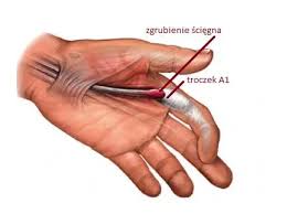 Znalezione obrazy dla zapytania palec