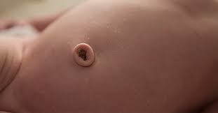 Attēlu rezultāti vaicājumam “Diderma umbilicatum young”