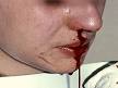 EPISTAXIS - Wikipedia, the free encyclopedia