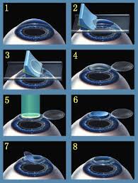 الاستجماتيزم Astigmatism Images?q=tbn:ANd9GcQkiVqm8RSYudKChGbuCMN_pdCw3wb0c0aByQa8vQXdyK5KOmFcpKcmkva5