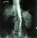 File:<b>Leriche's syndrome</b>.jpg