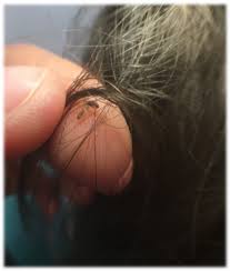 Attēlu rezultāti vaicājumam “Pediculus humanus capitis”