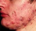 How to control and eliminate blackheads!