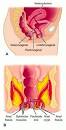 arteriovenous fistula - definition of arteriovenous fistula in the ...
