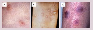 Attēlu rezultāti vaicājumam “Diderma simplex”