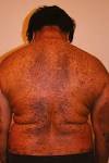 <b>Gardner's Syndrome</b>