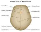 Craniosynostosis: Johns Hopkins Pediatric Neurosurgery